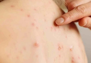 Dupilumab